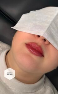 BOTOX & FILLERS 4 LIPFILLER AMSTELVEEN