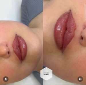 BOTOX & FILLERS 5 LIPFILLER AMSTELVEEN