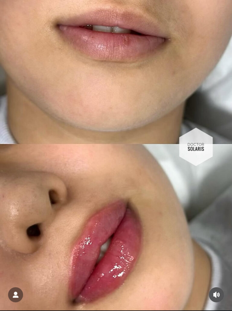 LIP FILLERS AMSTELVEEN